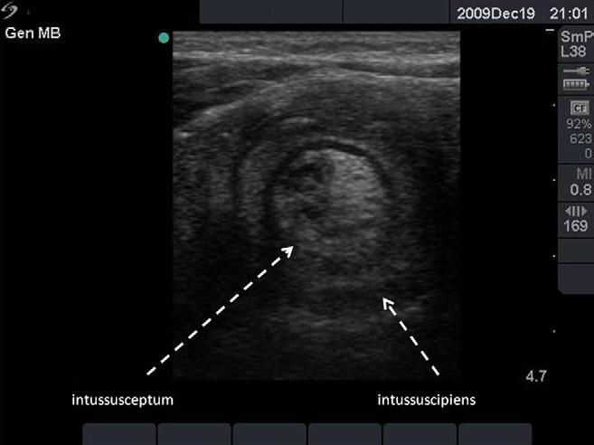 Riera et al Diagnosis of Intussusception in performance characteristics between individual bedside sonographers, and interrater variability was not assessed.