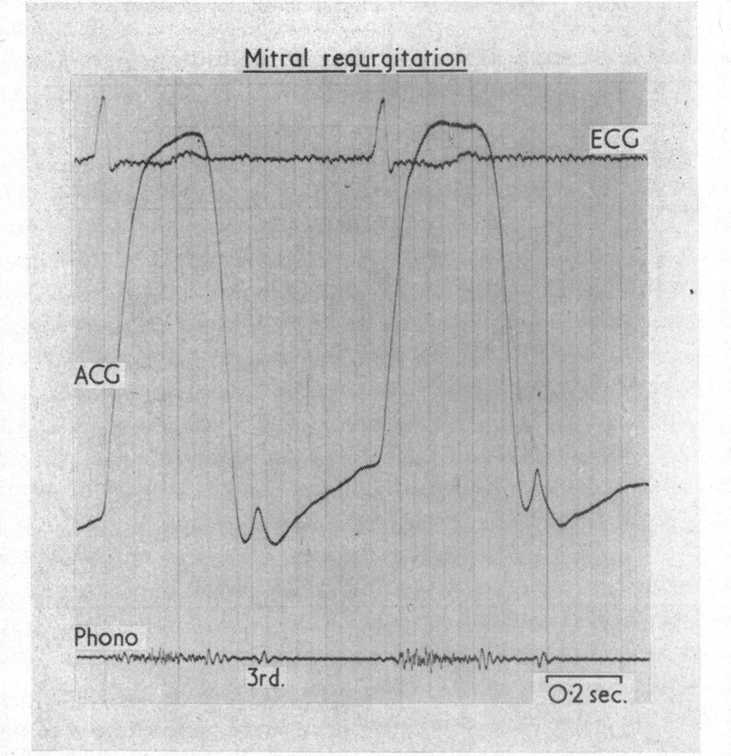 Evidence for a Mitral Valve Origin of the Left Ventricular Third Heart Sound 193 Mitralregurgitation f EC:EO JAC'' AG. Phono 3rd. 1-, b02 sec. W- FIG. 1.-Simultaneous phonocardiogram, apex cardiogram, and electrocardiogram.