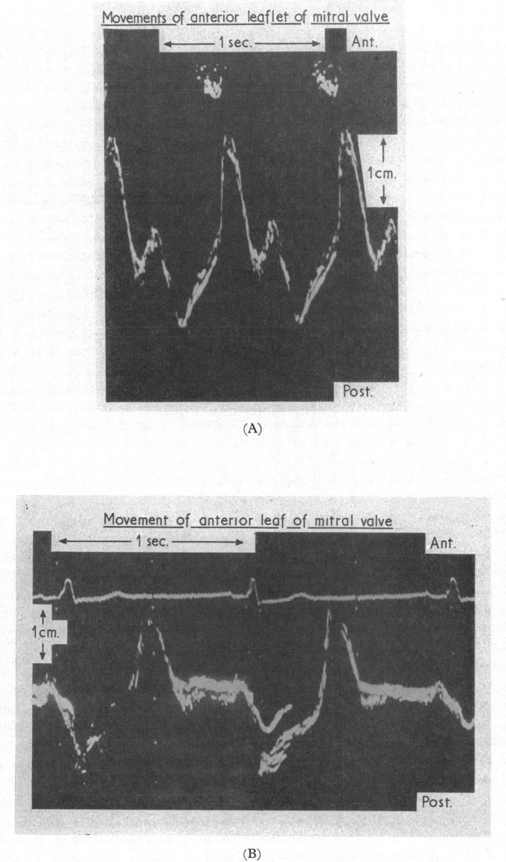 Evidence for a Mitral Valve Origin of the Left Ventricular Third Heart Sound 195 (A) Movement of 4-- I sec. (B) FIG. 3.