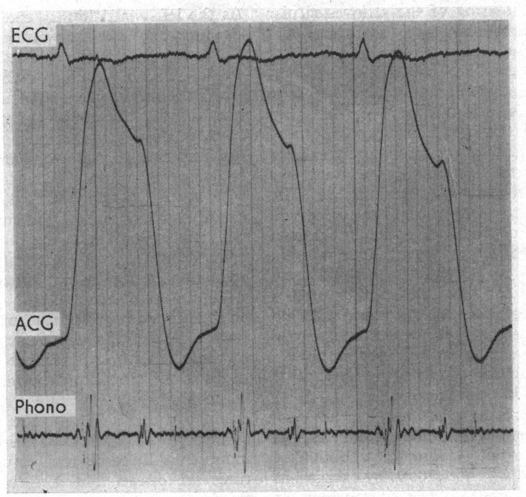 Evidence for a Mitral Valve Origin of the Left Ventricular Third Heart Sound -197 FIG. 55.