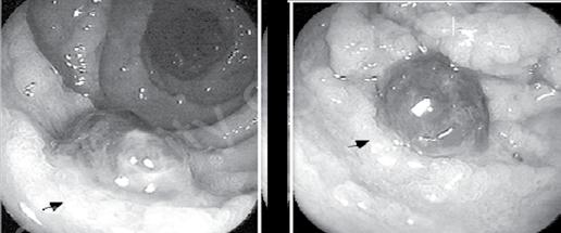 836 Medicine Update 2008 Vol. 18 Figure 3 Figure 4 clot can be mechanically removed from ulcers to uncover major stigmata of recent hemorrhage 26.