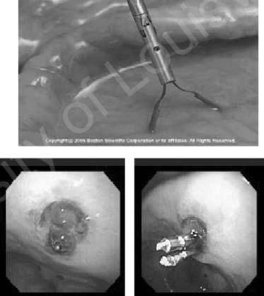 838 Medicine Update 2008 Vol. 18 due to technical constraints of the technique, laser therapy is not routinely used in the management of non-variceal UGIB.