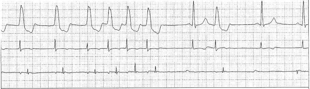 Clinical Case 36 y/o African-American male with palpitations, nearsyncope