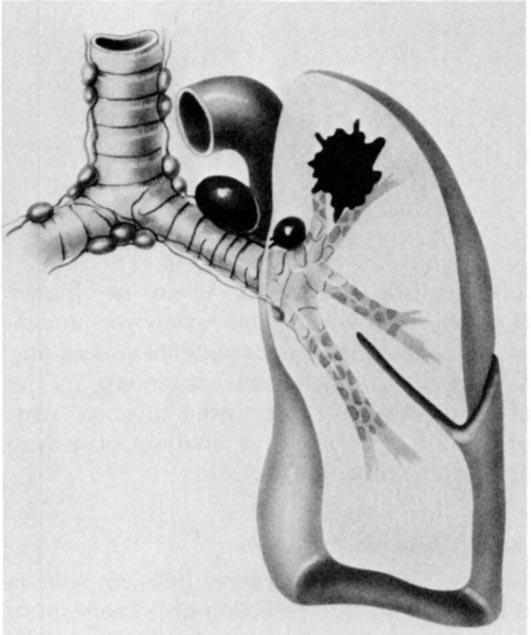 156 The Annals of Thoracic Surgery Vol 43 No 2 February 1987 Fig 1.