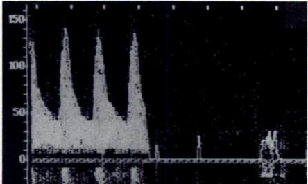 Transcranial Doppler waveform shows