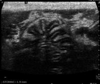 Stomach Ultrasound May have