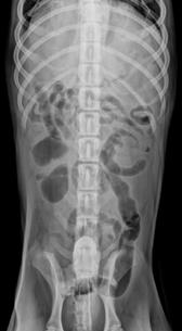 more radiopaque Megacolon Generalized enlargement of the colon Normally colon should be < length of L7 vertebral body Clinical Conditions Constipation & Obstipation Infrequent