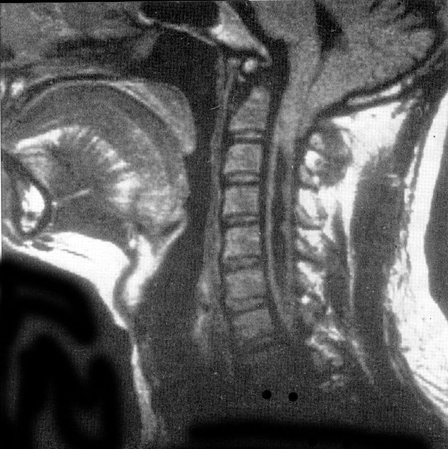 Syringomyelia formation of a cavity in the spinal cord running longitudinally for a variable number of segments.