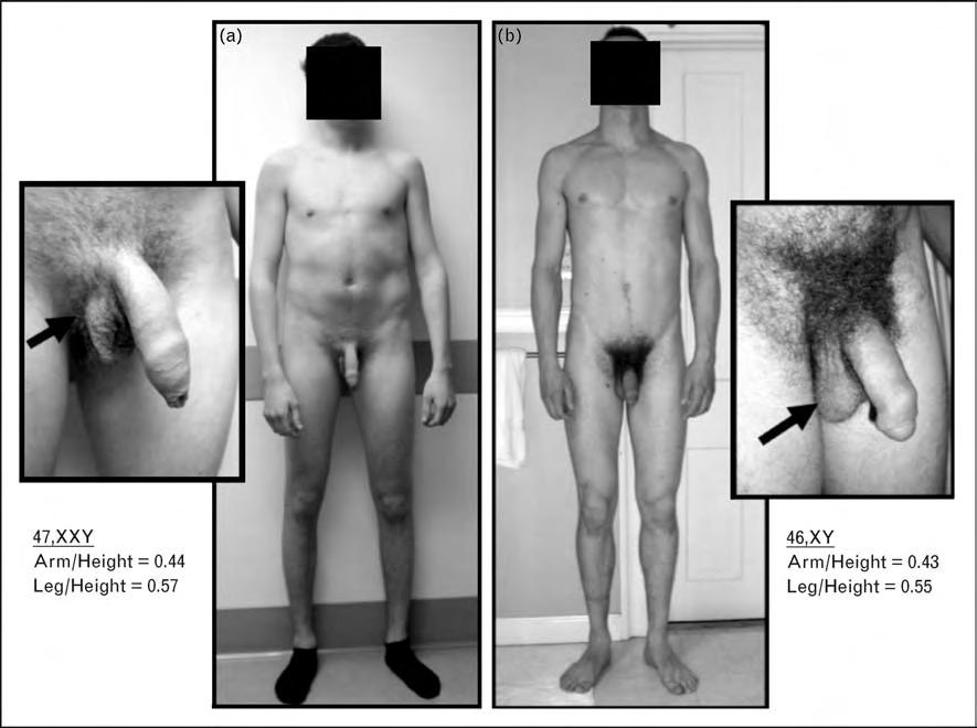 622 Andrology, sexual dysfunction and infertility Figure 1 The classic descriptions of men with Klinefelter syndrome are based on the most severe cases of phenotypic abnormalities Most teenagers and
