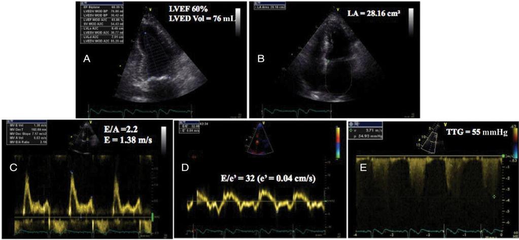 Diagnosis of heart failure with preserved left ventricular (LV) ejection fraction (EF) in a patient