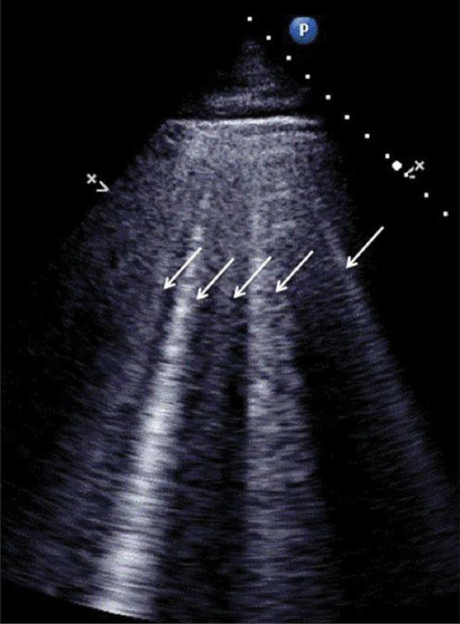 Transthoracic lung ultrasound reveals multiple sonographic B-lines (ultrasound lung comets, white arrows) in a