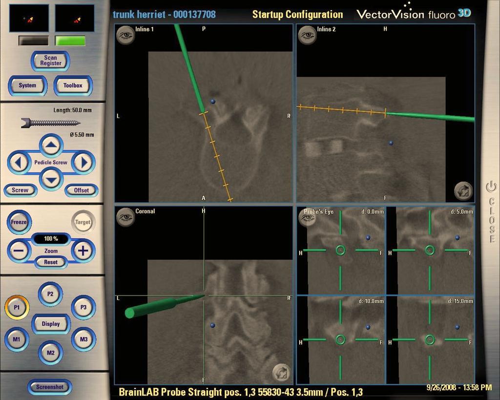230 The Open Orthopaedics Journal, 2010, Volume 4 Watkins IV et al. Fig. (1). Real-time images on the NaviVision monitor. The left picture is a sagittal view that guides cephalad-caudad insertion.