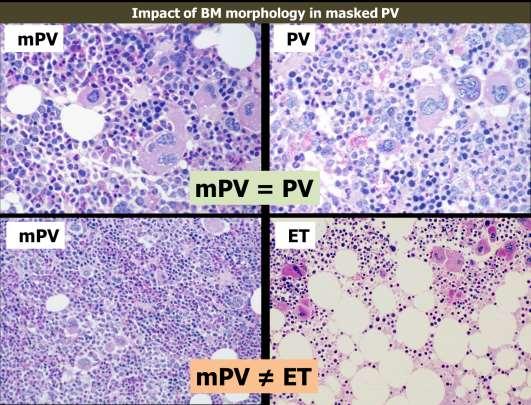 The rate of transformation from JAK2-mutated ET to PV is influenced by an accurate WHO-defined clinicomorphological diagnosis 5%