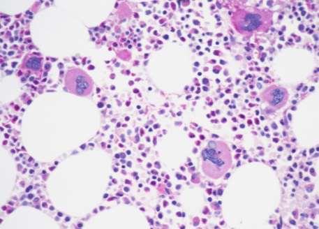 WHO criteria for ET Major criterion Bone marrow biopsy showing proliferation mainly