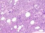 Leukoerythroblastosis Megakaryocytic