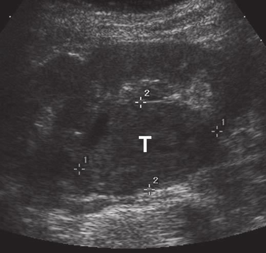 Ultrasound of Renal Masses A the tumor. Eight of 23 clear cell tumors, one of three papillary tumors, the chromophobe tumor, and all three oncocytomas were hyperechoic.