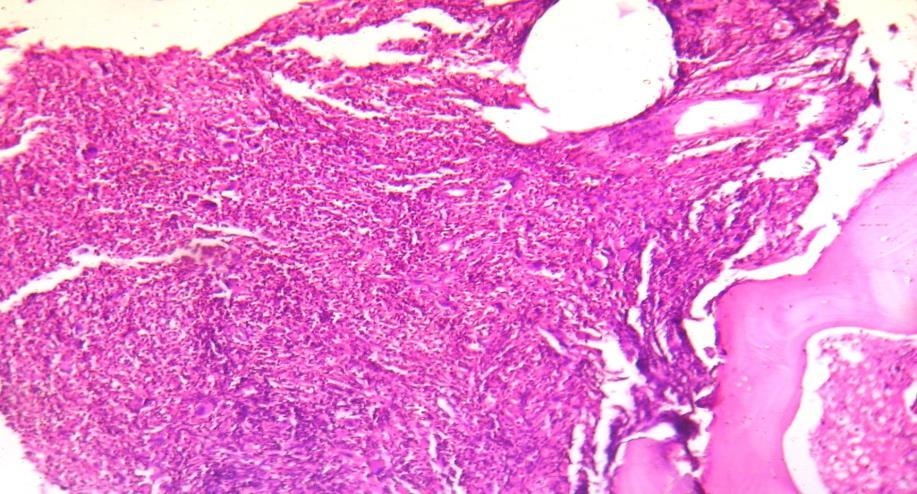 Fig. 8: H&E 10X Myelofibrosis Fig.
