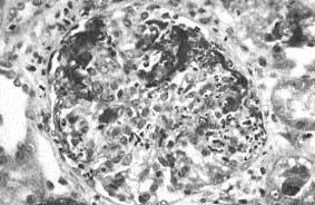 2.10 Systemic Diseases and the Kidney Pauci-immune crescentic glomerulonephritis Microscopic polyangiitis Wegener's granulomatosis P-ANCA/MPO-ANCA C-ANCA/PR3-ANCA FIGURE 2-22 Approximate relative