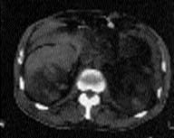 Both polyarteritis nodosa and Kawasaki disease cause acute necrotizing arteritis that may be complicated by thrombosis and hemorrhage.