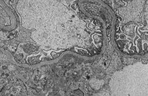 FIGURE 2-16 Direct immunofluorescence microscopy demonstrating granular, predominantly mesangial IgA-dominant immune complex deposits in a glomerulus.