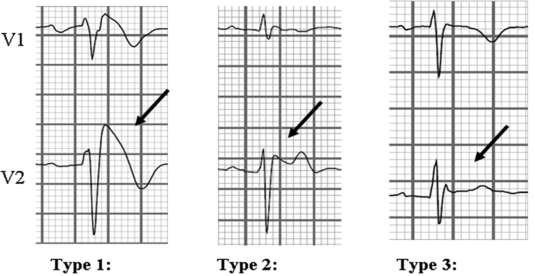 Brugada Syndrome Diagnosis and ECG pattern ECG pattern of Brugada Syndrome Diagnosis Type 1 ECG pattern At least