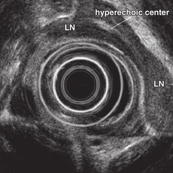 Mediastinal Lymph Node Staging Fig.