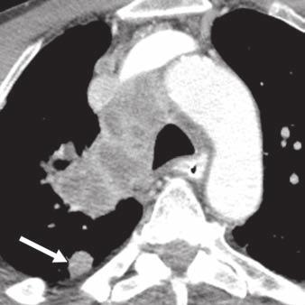 5 75-year-old man with N3 disease. A, Axial contrast-enhanced CT image (lung window) shows spiculated right upper lobe mass (arrow).