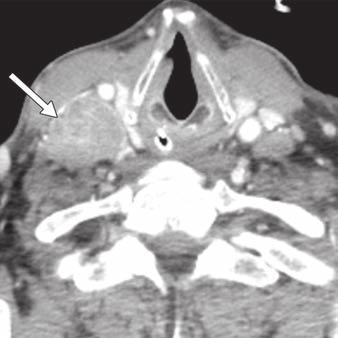 B, Axial contrast-enhanced CT image (mediastinal window) shows multiple enlarged lymph nodes in bilateral paratracheal and aorticopulmonary lymph