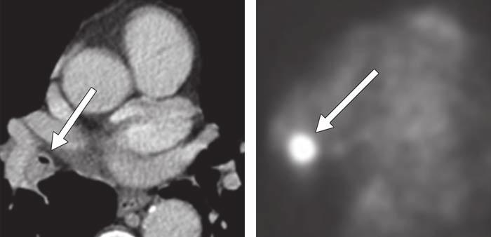 Mediastinal Lymph Node Staging CT Staging Modalities for NSCLC VATS/Thoracotomy Mediastinoscopy Navigational Bronchoscopy EBUS/EUS PET/CT TBNA Cumulative Staging Accuracy Clinical Pathologic Stage