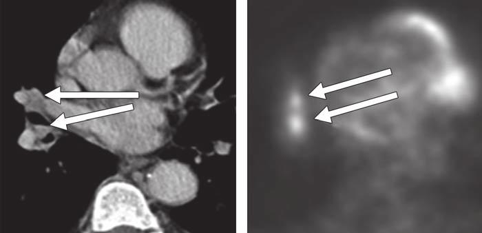 A, Axial contrast-enhanced CT image (left) shows endobronchial nodule (arrow) in bronchus intermedius.