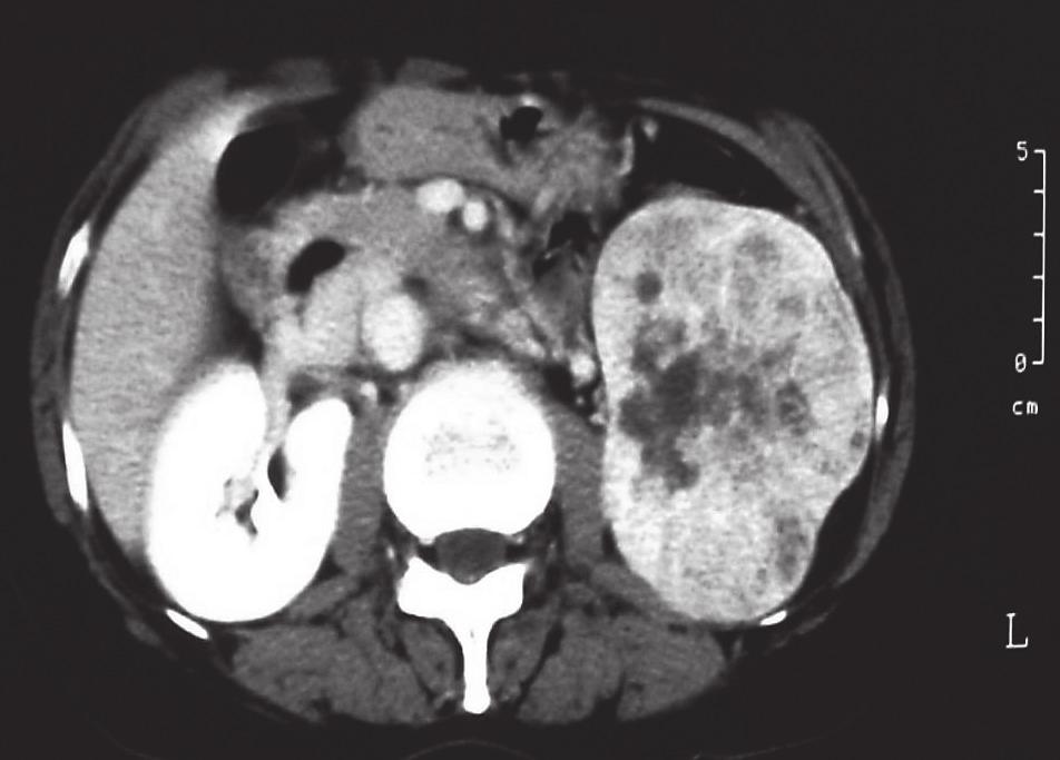 112 M. TOKUNAGA et al. Fig. 1 Abdominal CT scan shows a tumor with a diameter of 9 cm at the lower pole of the left kidney. a b Fig. 2 a: Chest CT scan shows mediastinal lymphadenopathy.