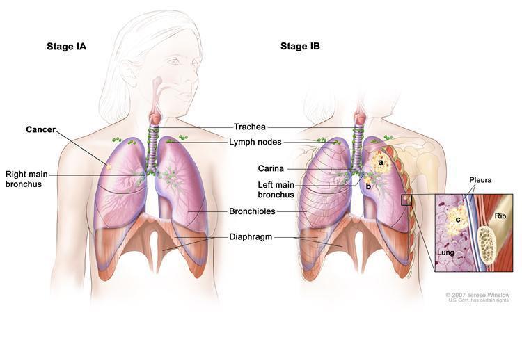 Stage IA, cancer is in the lung only, less than 3cm in size.
