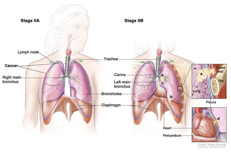 Stage IIA, cancer is less than 3cm in size and involves ipsilateral hilar lymph nodes.