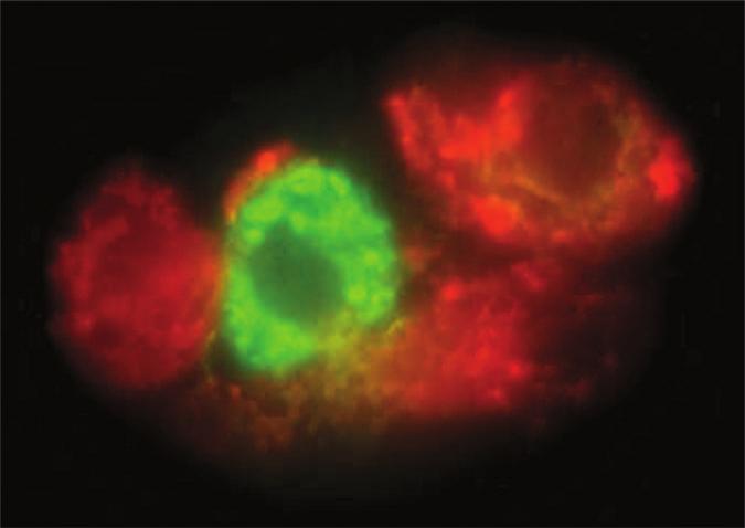 Figure 1. The ucyt immunofluorescence ssy from mlignnt urine cytology specimen demonstrting positive stining. One ntiody is directed ginst glycosylted crcinoemryonic ntigen leled with Texs Red (red).