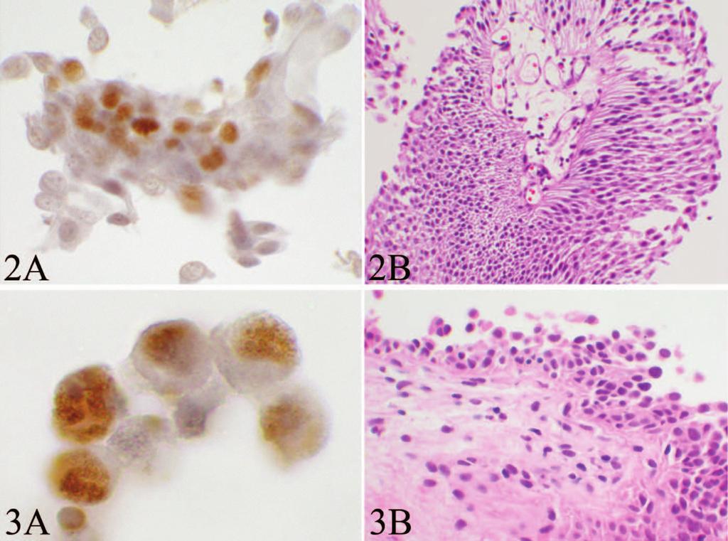 Figure 2. An exmple (cse 14; Tle 2) of typicl urine cytology showing positive rection with in cluster of typicl cells (A) nd histology follow-up of low-grde ppillry urothelil crcinom (B).