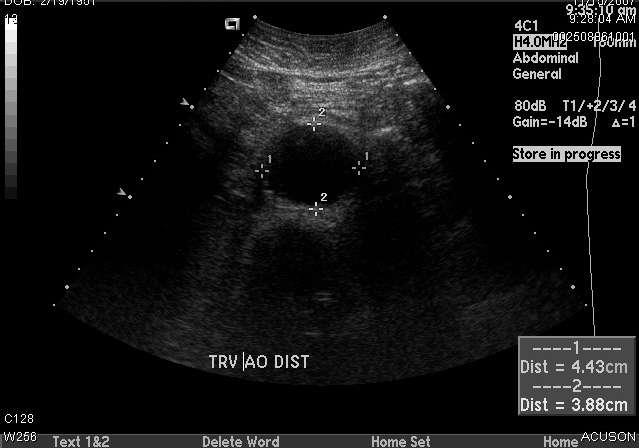 Mr. X Ultrasound 8/2008 Findings: Distal abdominal aortic aneurysm measuring 4.5 x 4.
