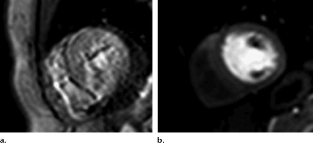 RG Volume 34 Number 6 Rajiah and Bolen 1627 Figure 12. Stress perfusion imaging at 1.5 T and 3 T. (a) Stress perfusion MR image at 1.5 T shows suboptimal spatial resolution and SNR.
