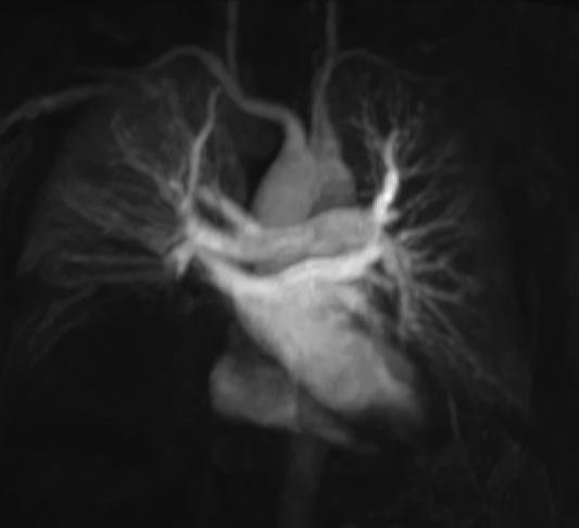 Use of 3 T allows acquisition of MR angiograms at lower contrast agent doses because of inherently higher SNR and CNR.
