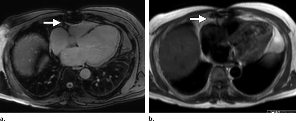 1620 October Special Issue 2014 radiographics.rsna.org Figure 6. Susceptibility artifacts. (a) SSFP MR image at 3 T shows a prominent susceptibility artifact from a median sternotomy wire (arrow).