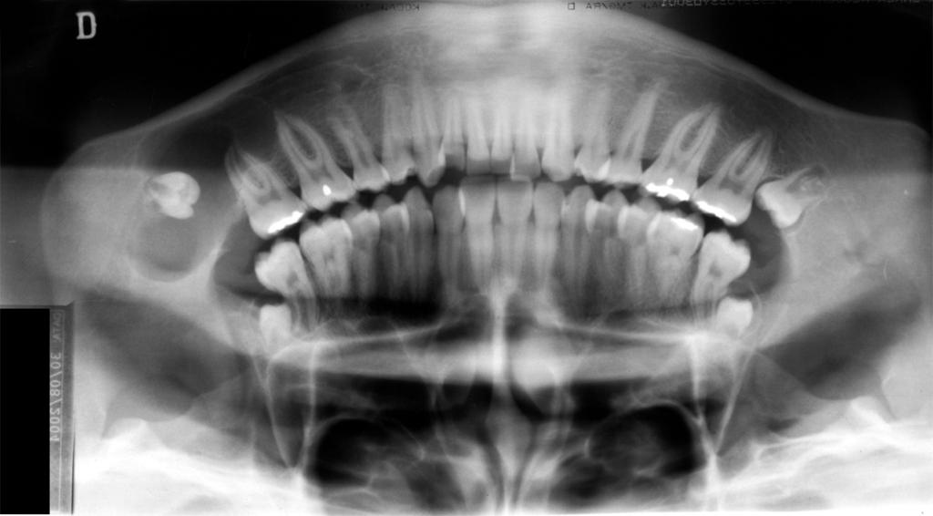 A panoramic radiograph was obtained and a marked expansion of the right mandibu- lar posterior region was seen.