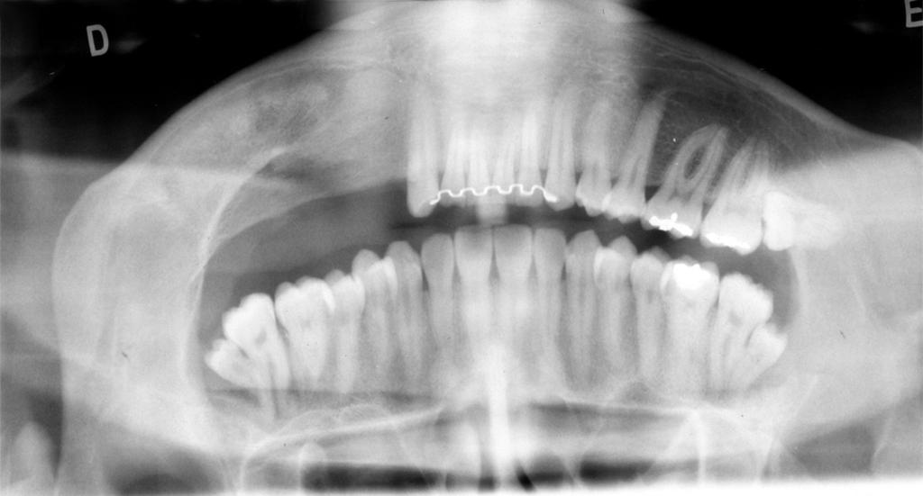 On the panoramic radiograph, acquired after one year and four months of using drains, a radiopaque area was seen in the region corresponding to the lesion, indicating bone neoformation.(fig.