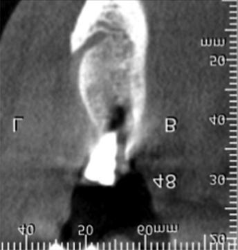 Cone-beam CT scans acquired at five years of follow-up did not show signs of recurrence.