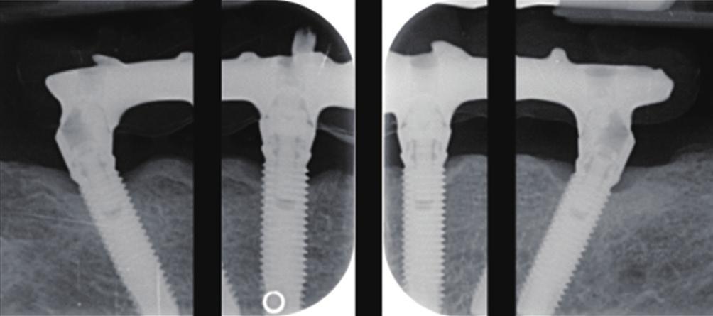 No relevant marginal bone resorption was detected. acceptable by a given classification. Nevertheless, marginal bone resorption was caused by peri-implantitis in only one implant in one subject.
