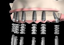 Unibase on Implant Unicover on Unibase UniScrew, available in blue (for