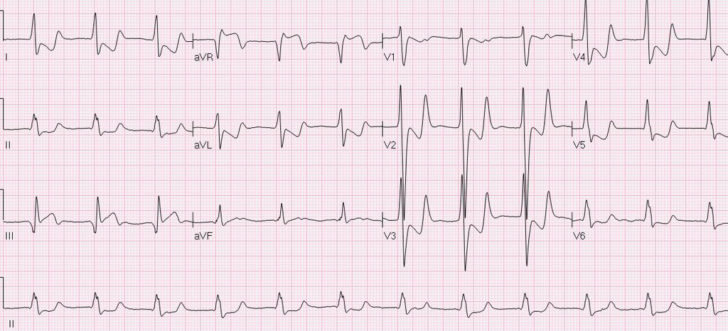 64 y/o with ESRD present with nausea/vomiting AV junctional rhythm/tachycardia, IVCD, nonspecific type, ST and/or T wave
