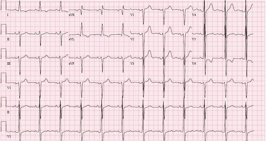 ECG 1 LVH with QRS and