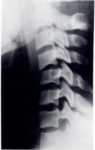 278 SCHER AJR:133, August 1979 Fig. 3.-Spinal injury with incomplete tetraplegia.