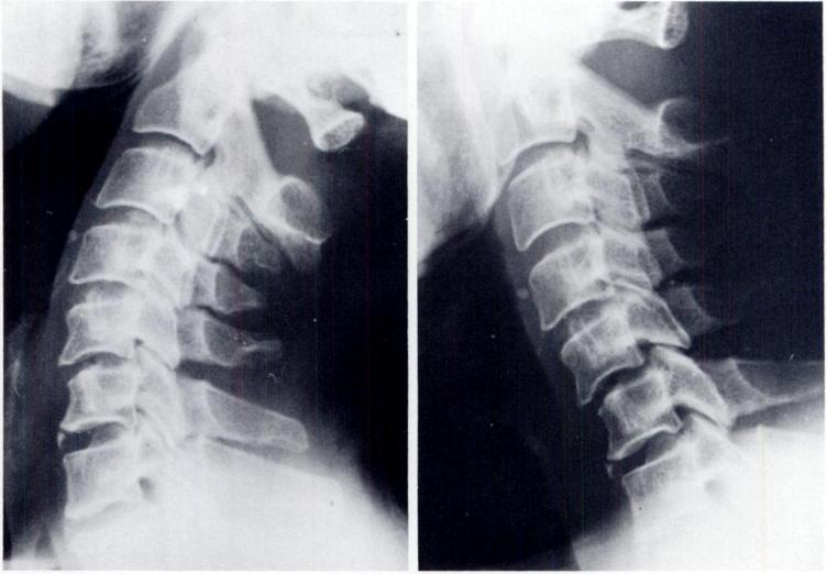 AJR:133, August 1979 ANTERIOR CERVICAL SUBLUXATION 279 Fig. 5.-A, Extension view. Divergence of spinous processes of C5 and C6.