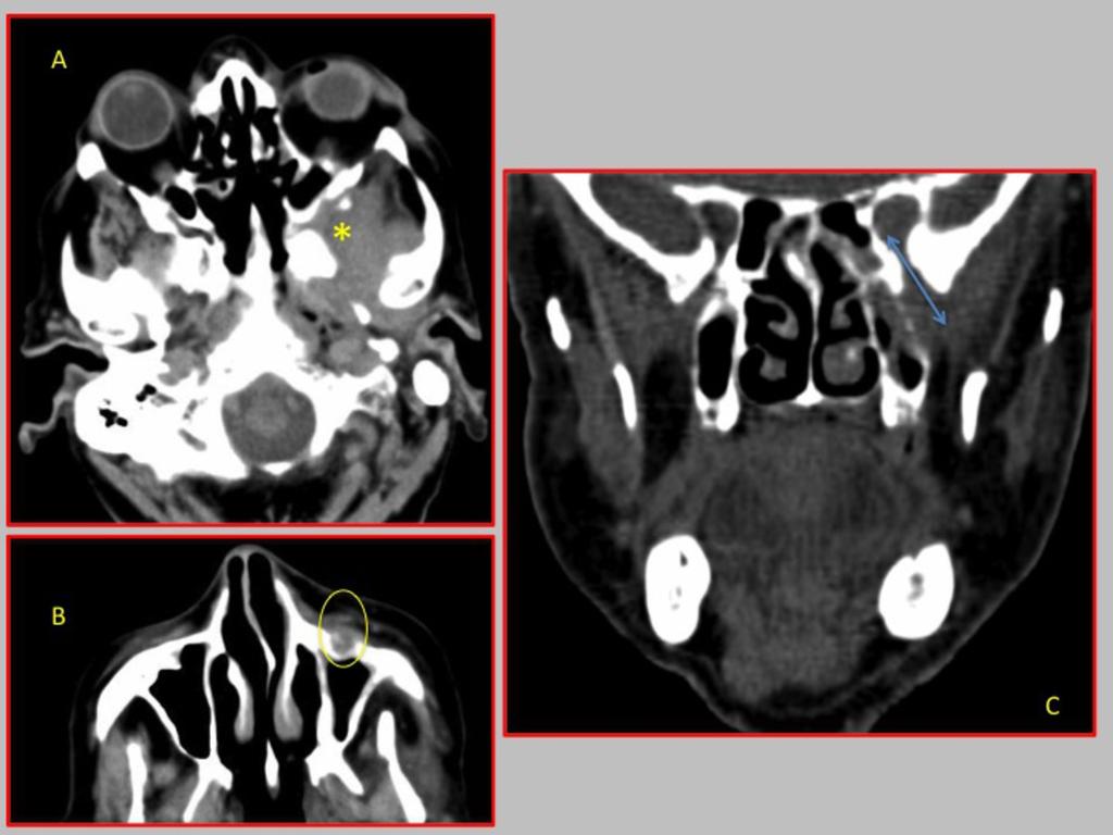 Fig. 16: 84 years old male, with exophthalmos and diplopia, which is diagnosed with squamous cell carcinoma nonkeratinizing extending perineural spread to middle cranial fossa and orbit coming