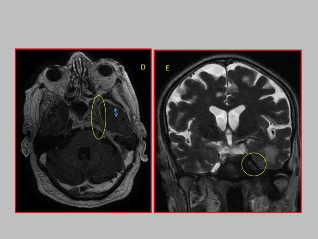 Fig. 17: 84 years old male, with exophthalmos and diplopia, which is diagnosed with squamous cell carcinoma nonkeratinizing extending perineural spread to middle cranial fossa and orbit coming